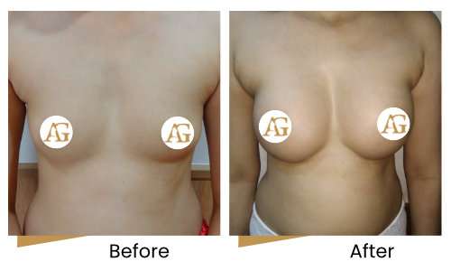 Breast augmentation