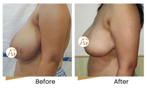 Breast reduction