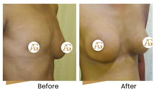 Congenital absent breast surgery