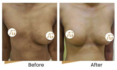 Congenital absent breast surgery