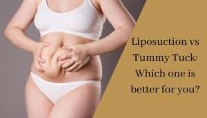 Liposuction vs Tummy Tuck Which one is better for you