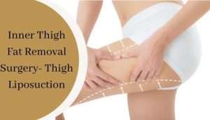 Inner thigh fat removal surgery
