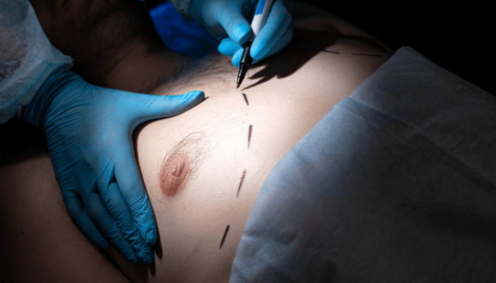 Gynecomastia surgery Mumbai