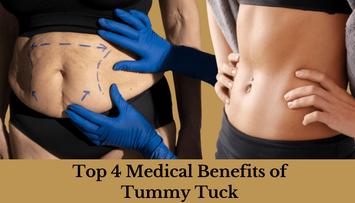 Tummy Tucks: Major Medical Benefit
