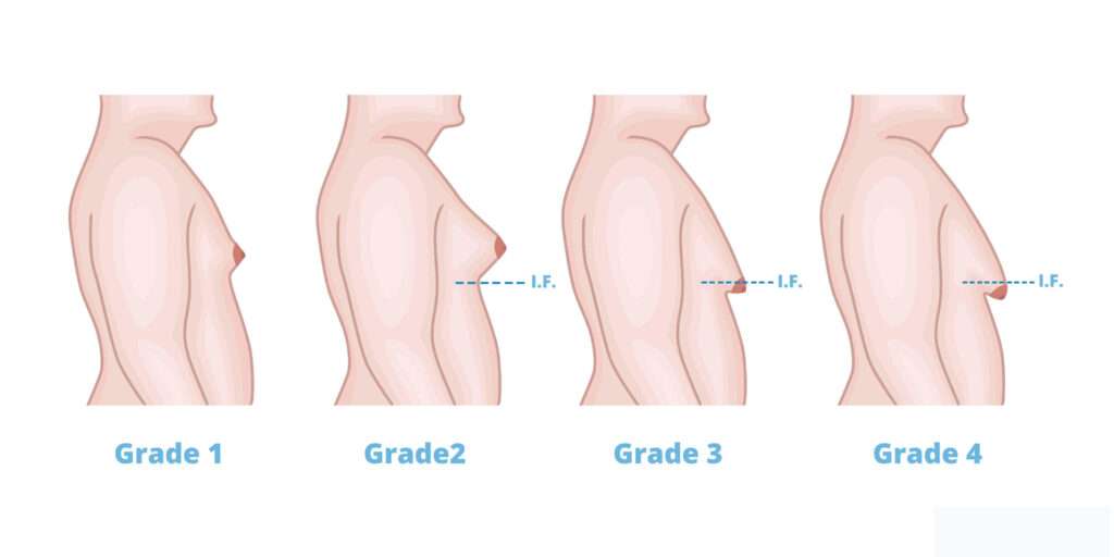 grades of gynecomastia