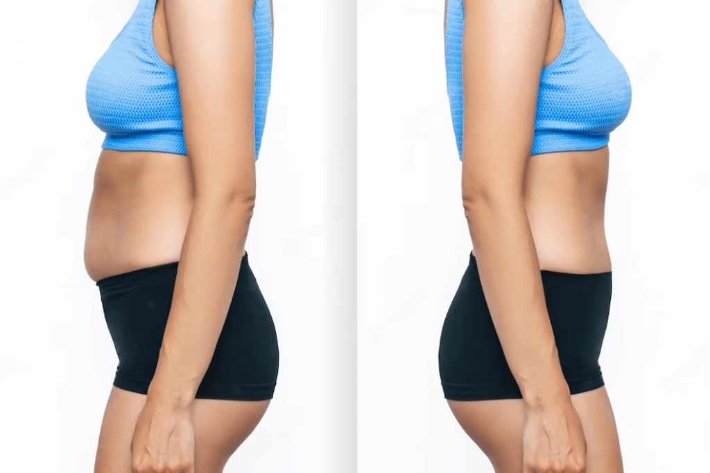 What is best tuck tuck or liposuction