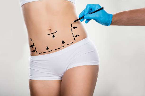 Close up of the markings of Tummy tuck procedure