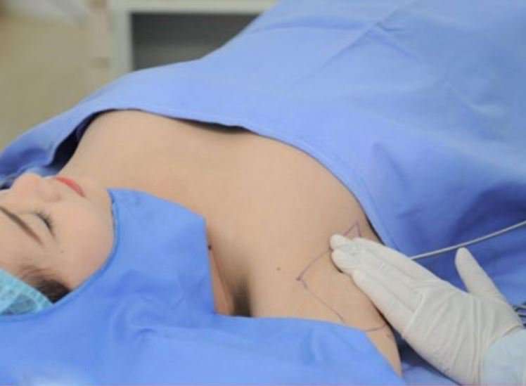 Axillary breast tissue removal