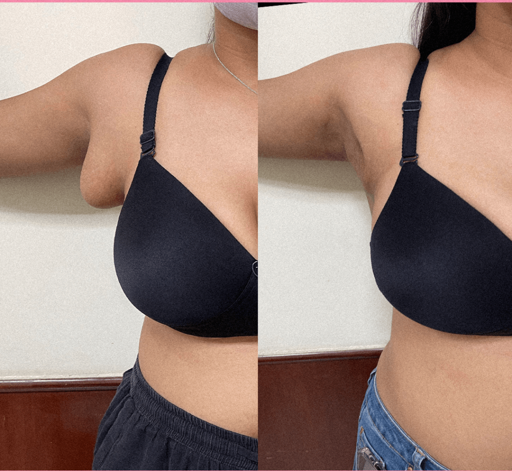 axillary breast tissue removal result