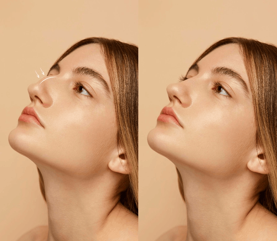Rhinoplasty surgery - Before and After
