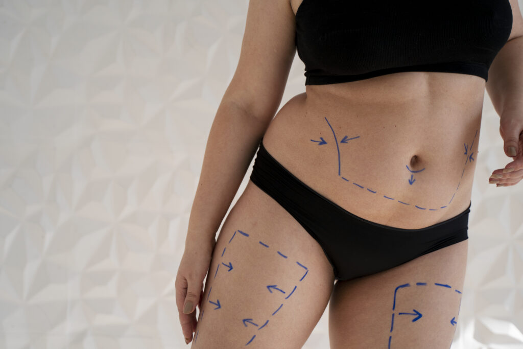 Liposuction