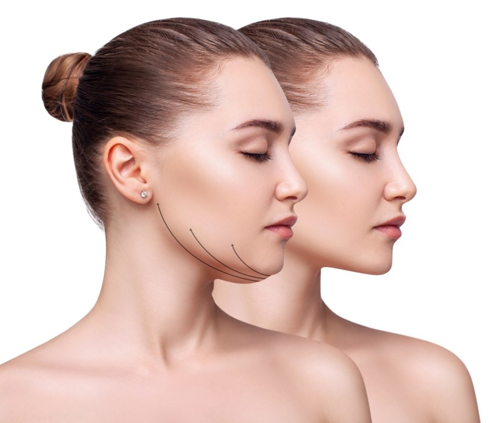 Neck Liposuction