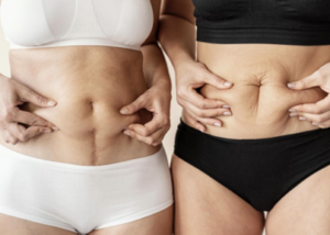 Tummy Tuck Surgery