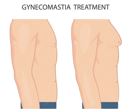 Gynaecomastia