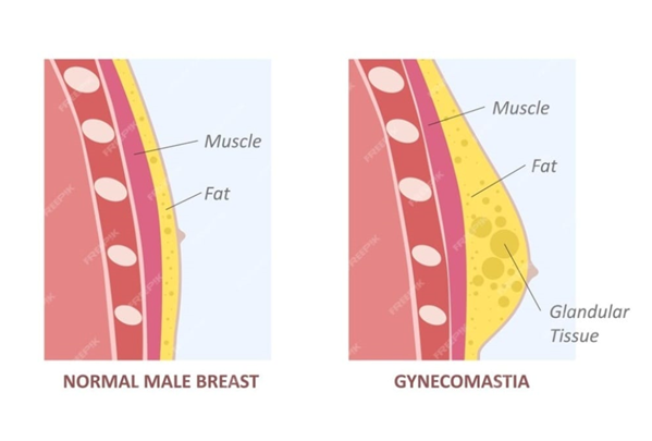 Gynaecomastia