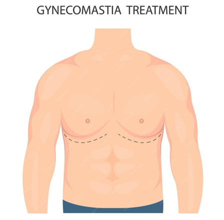 Gynaecomastia