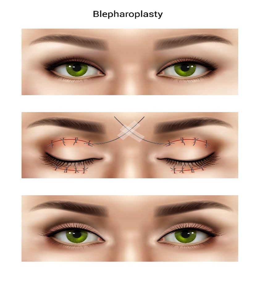 Blepharoplasty