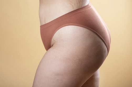 Buttock Augmentation