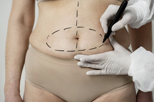 Liposuction