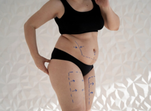 Liposuction