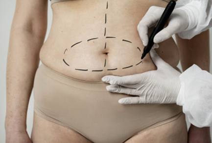 liposuction surgical procedure