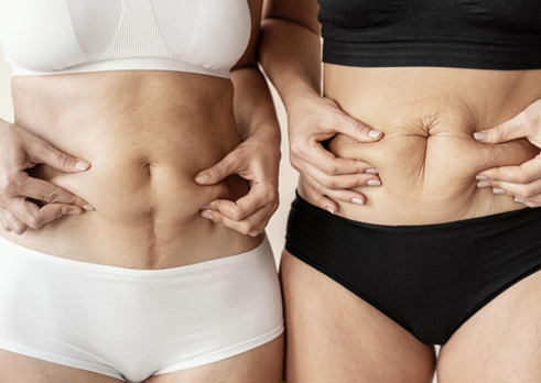 Tummy Tuck and Liposuction