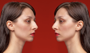 Rhinoplasty