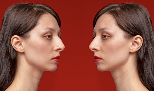 Rhinoplasty