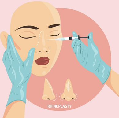 Rhinoplasty