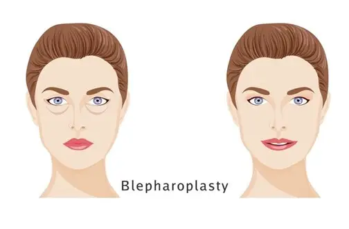 Blepharoplasty