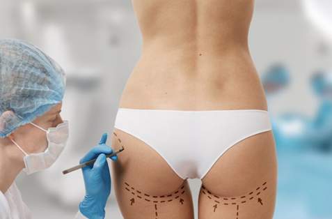 Buttock Augmentation