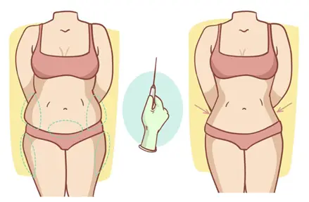 Liposuction