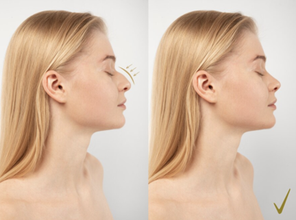 Rhinoplasty