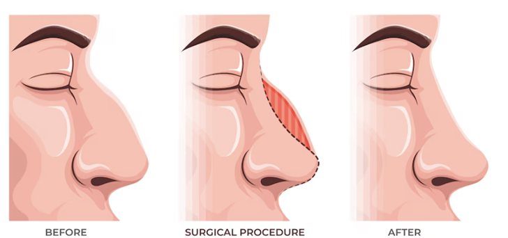 Rhinoplasty