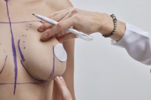 Breast Reduction Surgery