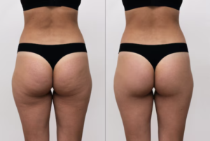 Buttock Augmentation