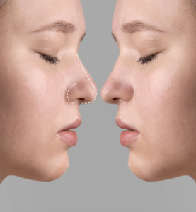 Scarless Rhinoplasty