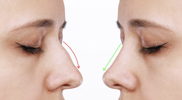 Rhinoplasty