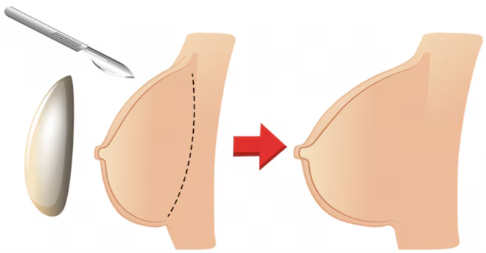 Breast Lift