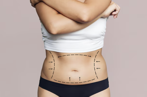 Liposuction