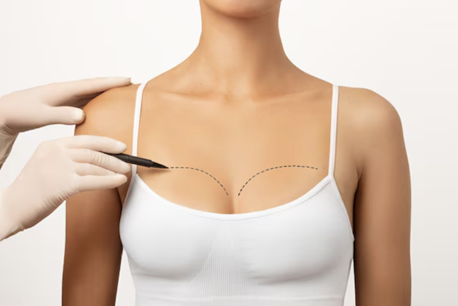Breast Lift