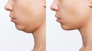 Neck Liposuction