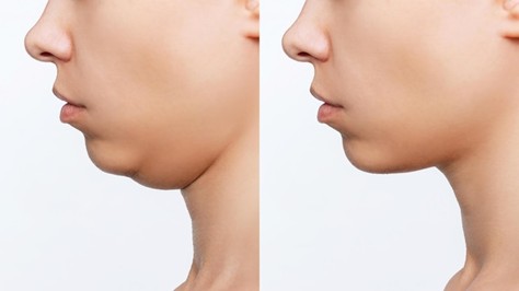 Neck Liposuction