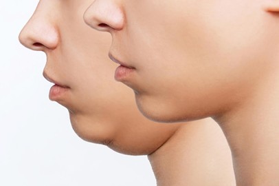 Neck Liposuction