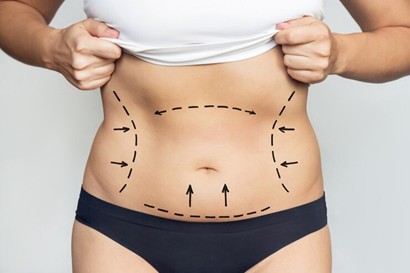 Tummy Tuck Surgery