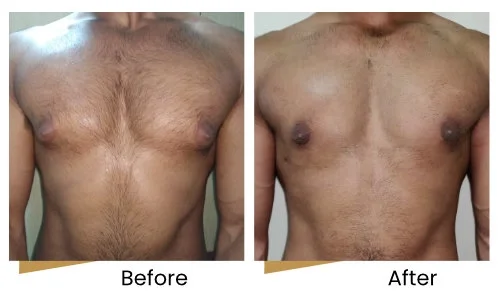 Gynecomastia Treatment Before After