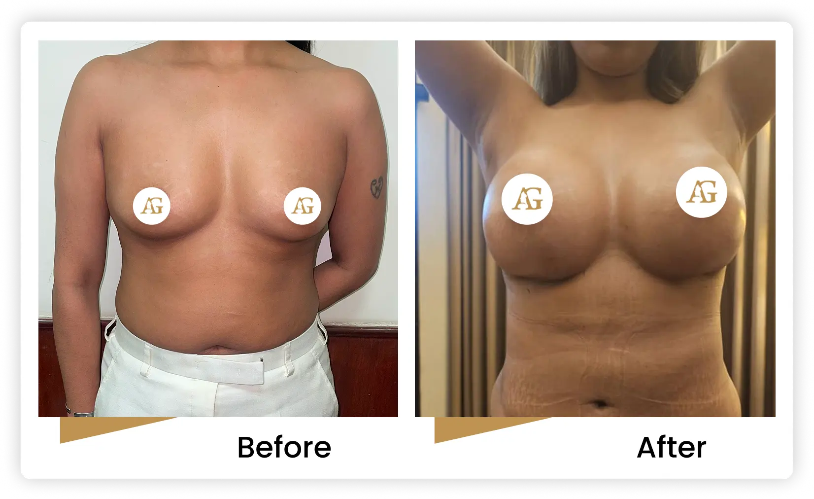 Breast Augmentation in Mumbai Before & After