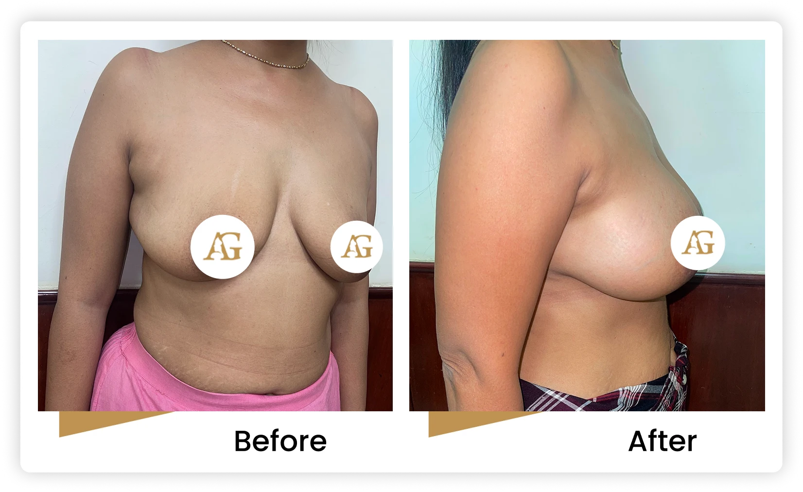 Breast Implant Augmentation Suregon in Mumbai