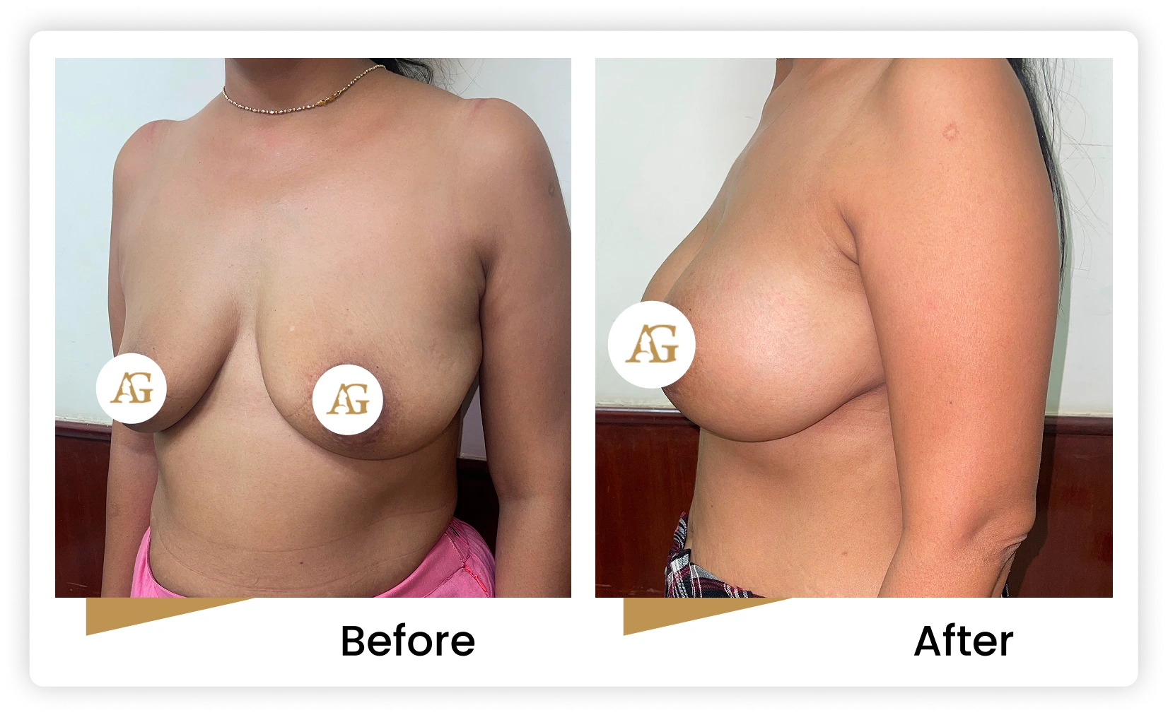 Breast Implant Augmentation Suregon in Mumbai