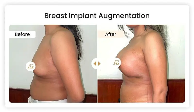 Breast Implant Augmentation in Mumbai